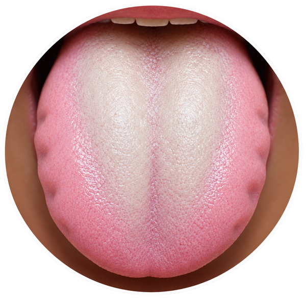 Puffy tongue with tooth marks and white greasy coating