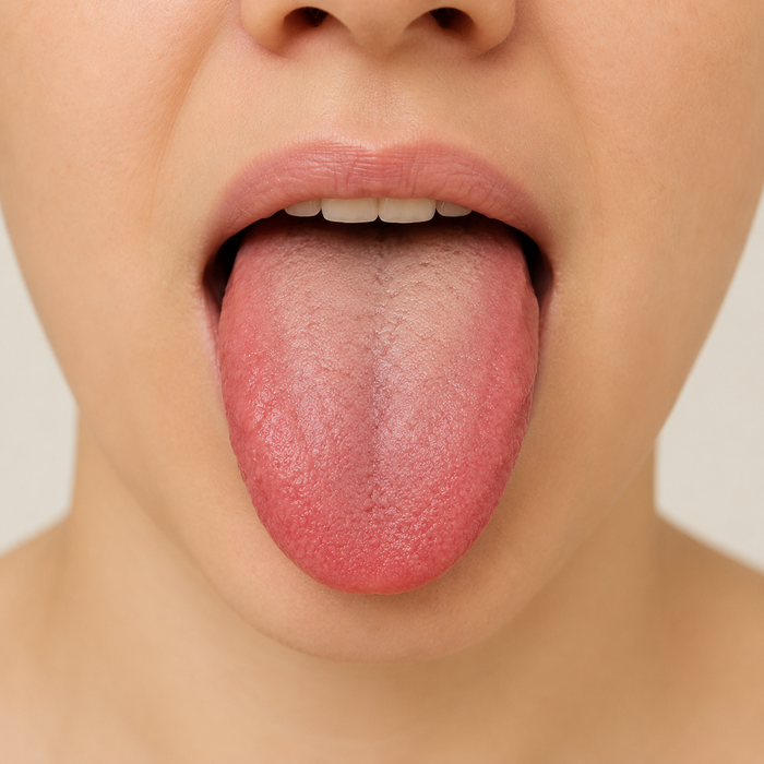 Tongue clue for Kidney Yin and fluid depletion